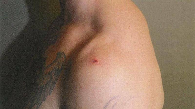 The puncture wound sustained by Mr Rolfe during the scuffle. Picture: Supreme Court of the NT.